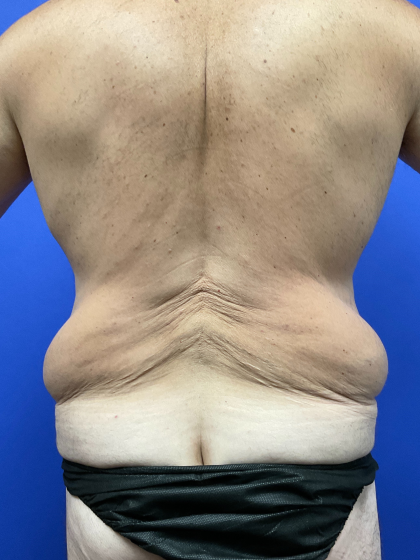 Post Weight Loss Before & After Patient #9776