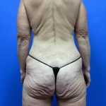 Body Lift - Hemicircumferential Before & After Patient #9800