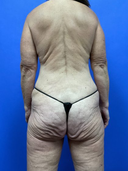 Body Lift - Hemicircumferential Before & After Patient #9800