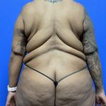 Upper Body Lift Before & After Patient #9801