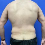 Flankplasty Before & After Patient #9777