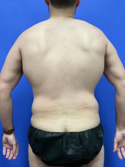 Flankplasty Before & After Patient #9777