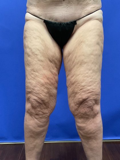 Thighplasty Before & After Patient #9732