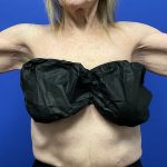 Arm Lift Before & After Patient #9821