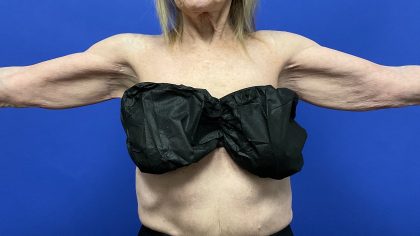 Mini Arm Lift Before & After Patient #9821