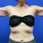 Arm Lift Before & After Patient #9826