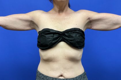 Arm Lift Before & After Patient #9826