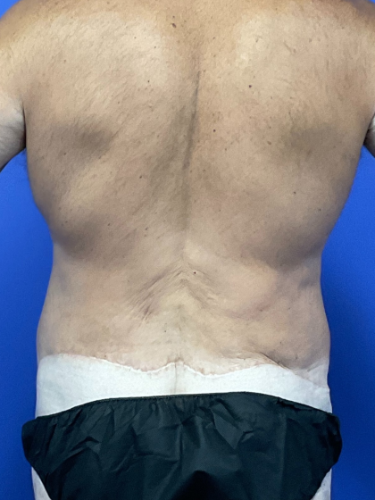 Post Weight Loss Before & After Patient #9776
