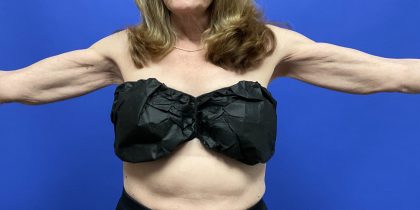 Mini Arm Lift Before & After Patient #9816