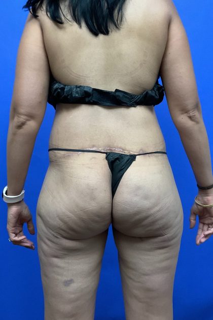 Body Lift - Hemicircumferential Before & After Patient #9799