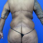 Upper Body Lift Before & After Patient #9801