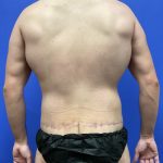 Flankplasty Before & After Patient #9777