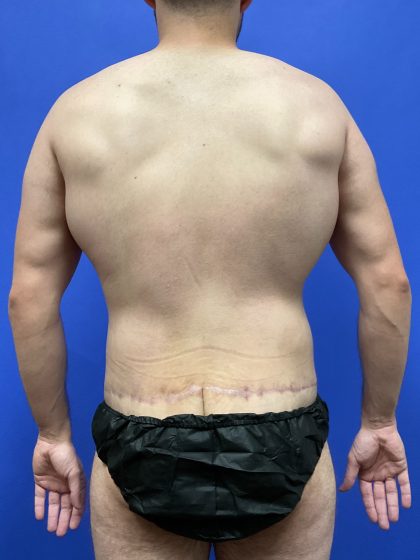 Flankplasty Before & After Patient #9777