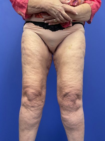 Thighplasty Before & After Patient #9732