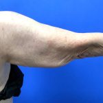 Arm Lift Before & After Patient #9821
