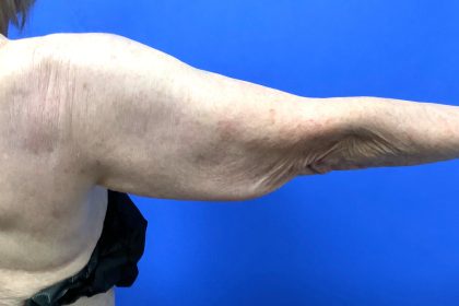 Arm Lift Before & After Patient #9821