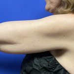 Arm Lift Before & After Patient #9816