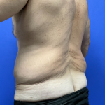 Post Weight Loss Before & After Patient #9776