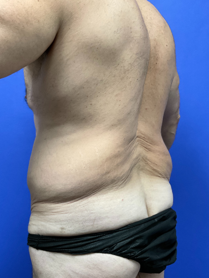 Post Weight Loss Before & After Patient #9776