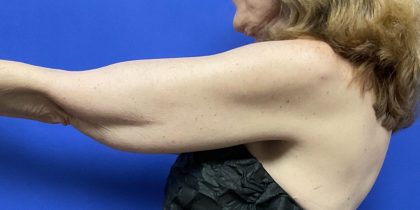 Arm Lift Before & After Patient #9816