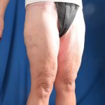 Thighplasty Before & After Patient #9731