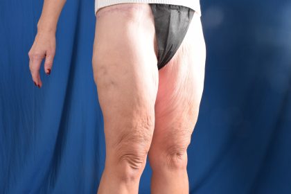 Thighplasty Before & After Patient #9731