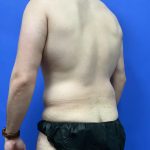 Flankplasty Before & After Patient #9777