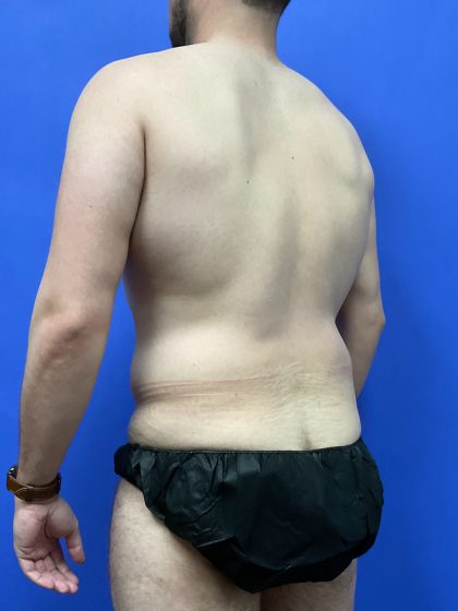 Flankplasty Before & After Patient #9777