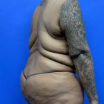 Upper Body Lift Before & After Patient #9801