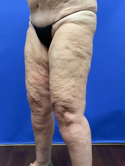 Thighplasty Before & After Patient #9732
