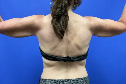 Arm Lift Before & After Patient #9826