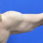 Arm Lift Before & After Patient #9821