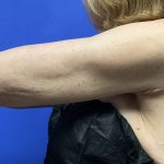 Arm Lift Before & After Patient #9816