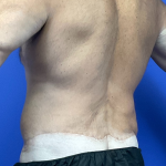 Post Weight Loss Before & After Patient #9776