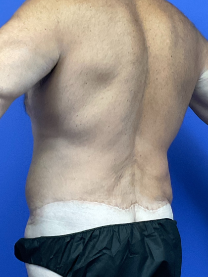 Post Weight Loss Before & After Patient #9776