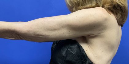 Arm Lift Before & After Patient #9816