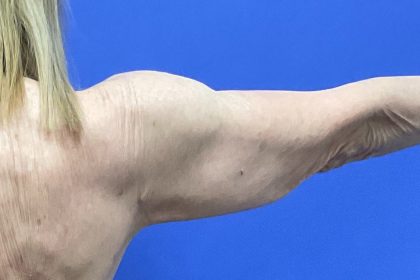 Arm Lift Before & After Patient #9821
