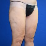 Thighplasty Before & After Patient #9731