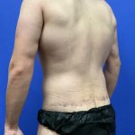 Flankplasty Before & After Patient #9777