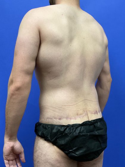 Flankplasty Before & After Patient #9777