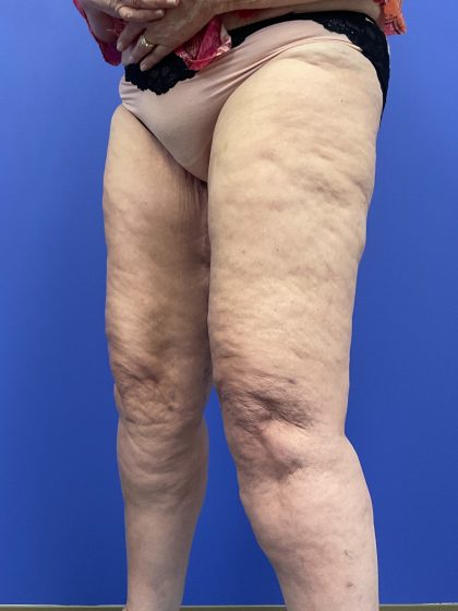 Thighplasty Before & After Patient #9732