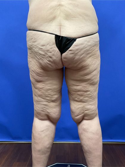Thighplasty Before & After Patient #9732