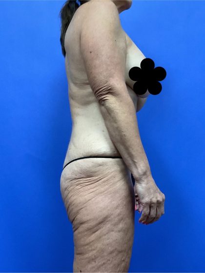 Body Lift - Hemicircumferential Before & After Patient #9800