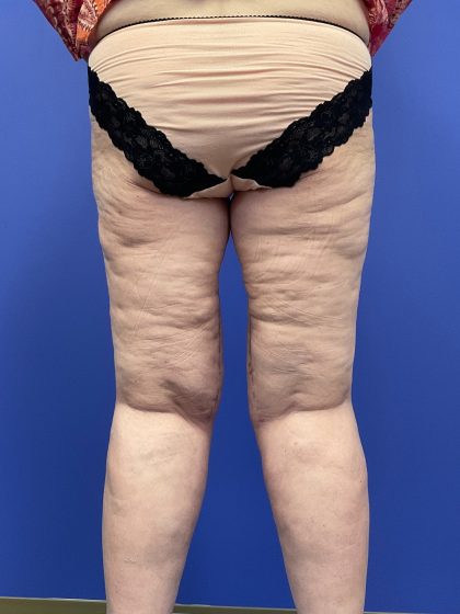 Thighplasty Before & After Patient #9732