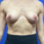 Standard Liposuction Before & After Patient #9856