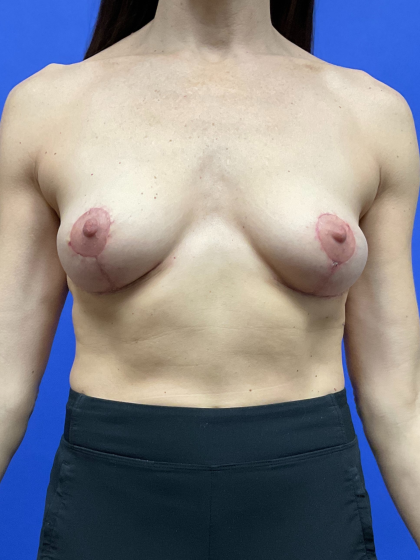 Standard Liposuction Before & After Patient #9856