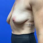 Standard Liposuction Before & After Patient #9856
