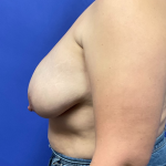 Breast Implant Removal Before & After Patient #9857