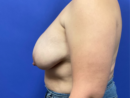 Breast Implant Removal Before & After Patient #9857