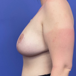 Breast Lift/Reduction Before & After Patient #9859